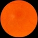 Macular Hole