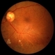 PDR with Traction RD of Macular PDR with Traction RD of Macular