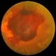 PDR with Severe Subhyaloid Hemorrhage PDR with Severe Subhyaloid Hemorrhage