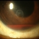 Hyphema Hyphema