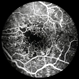 PDR with Foveal Ischemia and FAZ Enlargement PDR with Foveal Ischemia and FAZ Enlargement