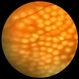 PRP Day Of Treatment PRP Day Of Treatment