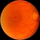 Macular Hole Macular Hole