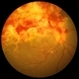 Cytomegalovirus Retinitis with Papillary Involvement Cytomegalovirus Retinitis with Papillary Involvement