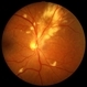 Cytomegalovirus Retinitis with Papillary Involvement Cytomegalovirus Retinitis with Papillary Involvement