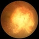 Sarcoid Granuloma of Optic Nerve Sarcoid Granuloma of Optic Nerve