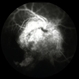 Sarcoid Granuloma of Optic Nerve Sarcoid Granuloma of Optic Nerve