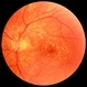 Cat Scratch Retinitis with Macular Lipid Cat Scratch Retinitis with Macular Lipid