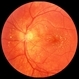Cat Scratch Retinitis with Macular Lipid Resolving Cat Scratch Retinitis with Macular Lipid Resolving
