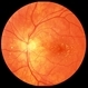 Cat Scratch Retinitis with Macular Lipid Resolving Cat Scratch Retinitis with Macular Lipid Resolving