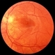 Cat Scratch Retinitis with Macular Lipid Resolved Cat Scratch Retinitis with Macular Lipid Resolved