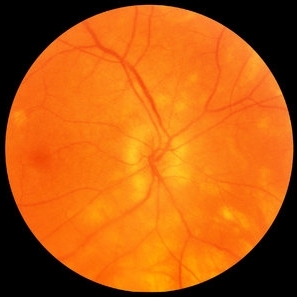 Birdshot Chorioretinopathy - Retina Image Bank