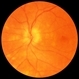 Birdshot Chorioretinopathy  FA with Optic Nerve Leakage Left Eye Birdshot Chorioretinopathy  FA with Optic Nerve Leakage Left Eye