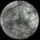 Birdshot Chorioretinopathy  FA with Patchy Choroidal Filling Left Eye Birdshot Chorioretinopathy  FA with Patchy Choroidal Filling Left Eye