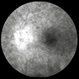 Birdshot Chorioretinopathy  FA with Optic Nerve Leakage Left Eye Birdshot Chorioretinopathy  FA with Optic Nerve Leakage Left Eye