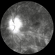 Birdshot Chorioretinopathy  FA with Optic Nerve Leakage Left Eye Birdshot Chorioretinopathy  FA with Optic Nerve Leakage Left Eye