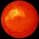 Cytomegalovirus Retinitis Active Cytomegalovirus Retinitis Active