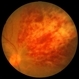 Cytomegalovirus Retinitis with Severe Hemorrhage and Exudate Right Eye Cytomegalovirus Retinitis with Severe Hemorrhage and Exudate Right Eye