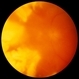 Acute Retinal Necrosis Acute Retinal Necrosis