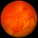 Acute Retinal Necrosis Acute Retinal Necrosis