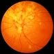 Cytomegalovirus Retinitis with Papilitis Cytomegalovirus Retinitis with Papilitis