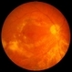 Cytomegalovirus Retinitis Partially Regressed on Ganciclovir Cytomegalovirus Retinitis Partially Regressed on Ganciclovir