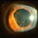 Toxoplasmosis Uveitis with Mutton Fat KP and Broken Posterior Synechia Toxoplasmosis Uveitis with Mutton Fat KP and Broken Posterior Synechia