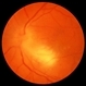 Toxoplasmosis Chorioretinitis Toxoplasmosis Chorioretinitis