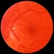 HIV Retinopathy with Very Early Cytomegalovirus Retinitis HIV Retinopathy with Very Early Cytomegalovirus Retinitis