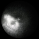 Toxoplasmosis Chorioretinitis Toxoplasmosis Chorioretinitis