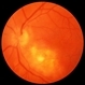 Toxoplasmosis Chorioretinitis Toxoplasmosis Chorioretinitis