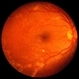 Systemic Lupus Erythematosus Vasculitis Systemic Lupus Erythematosus Vasculitis