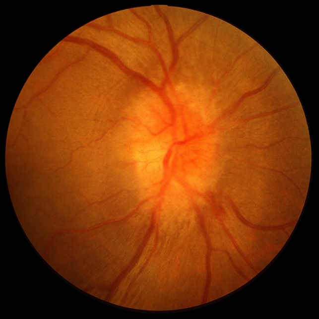 How to treat optic neuritis