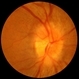 Syphilitic Optic Neuritis Syphilitic Optic Neuritis