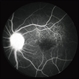 Syphilitic Optic Neuritis CF Syphilitic Optic Neuritis CF