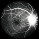Syphilitic Optic Neuritis CF Syphilitic Optic Neuritis CF