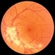 Cytomegalovirus Retinitis, Active, with Papillary Involvement Cytomegalovirus Retinitis, Active, with Papillary Involvement