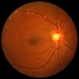 Sarcoid Vasculitis Sarcoid Vasculitis