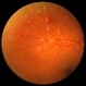Sarcoid Vasculitis Sarcoid Vasculitis