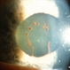 Broken Posterior Synechia in Eye Broken Posterior Synechia in Eye