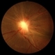 Optic Nerve ERM Optic Nerve ERM