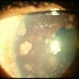 Sarcoid Bussaca Iris Nodules Sarcoid Bussaca Iris Nodules