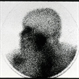 Gadolinium Scan in Sarcoidosis Gadolinium Scan in Sarcoidosis