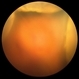 Choroidal Detachment Choroidal Detachment