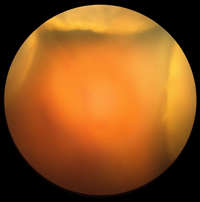 choroidal detachment icd 10