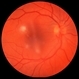 Candida Endophthalmitis Candida Endophthalmitis