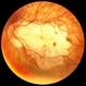 Myopic Macular Degeneration Myopic Macular Degeneration