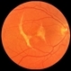 Choroidal Rupture Choroidal Rupture