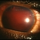 Hyphema Hyphema