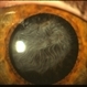 Anterior Capsule Opacification in Eye Anterior Capsule Opacification in Eye